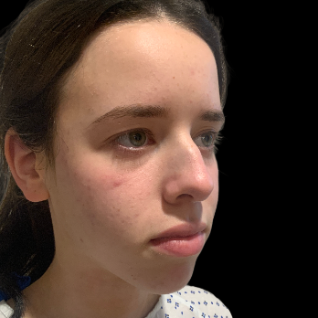 preservation-rhinoplasty-before